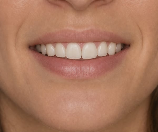The same patient's smile after porcelain veneers