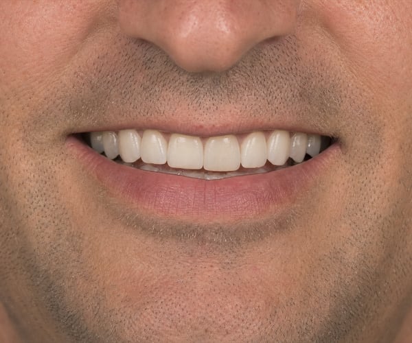 The same patient's smile after treatment