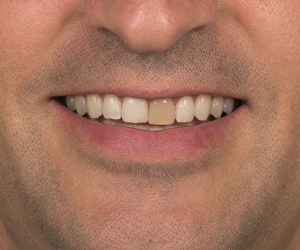 A second patient's smile before treatment