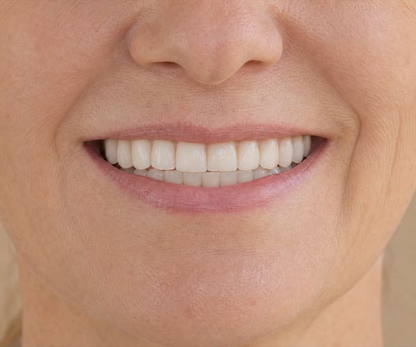 The same patient's smile after treatment