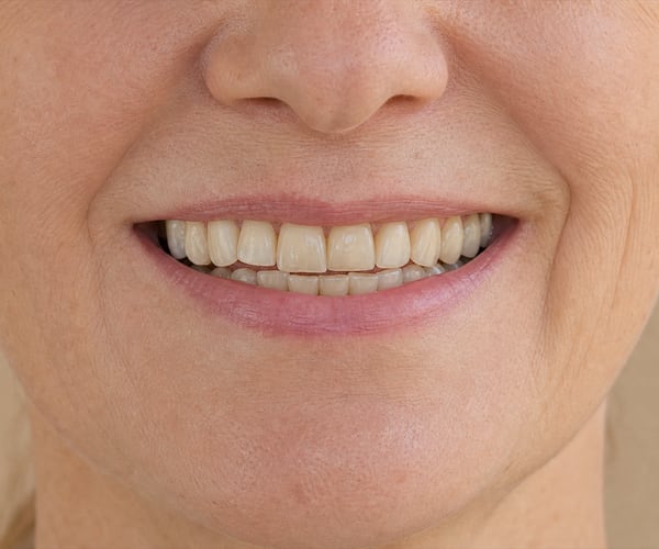 A third patient's smile before treatment